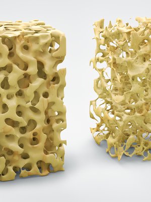 Terve ja haurastunut luu. Kuva Shutterstock