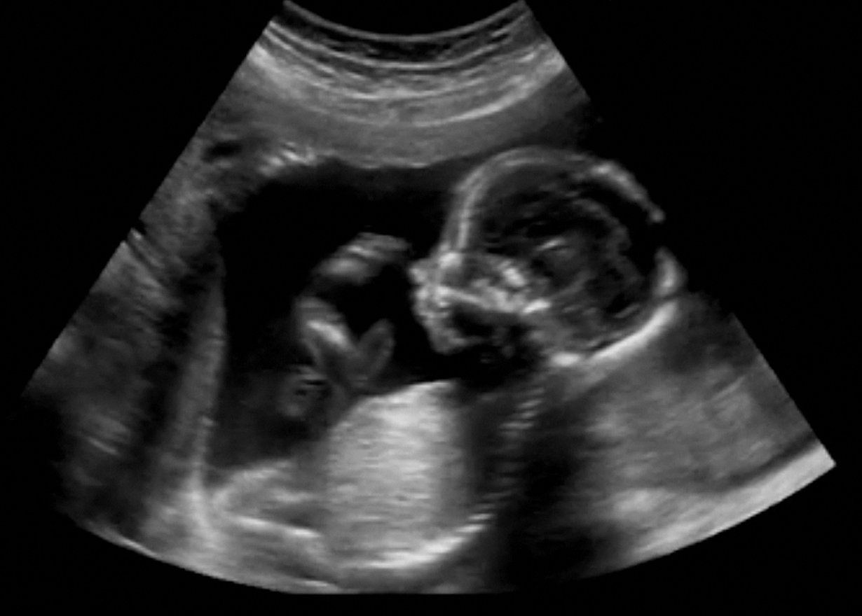 Ultraäänitutkimuksessa vauvasta otetaan ensimmäiset mitat. Muun muassa niiden perusteella arvioidaan, onko sikiö terve.