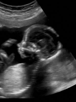 Ultraäänitutkimuksessa vauvasta otetaan ensimmäiset mitat. Muun muassa niiden perusteella arvioidaan, onko sikiö terve.