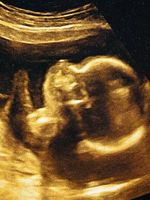 Alkoholi imeytyy istukan kautta sikiöön, eikä sikiön maksa pysty polttamaan alkoholin kaltaista myrkyllistä ainetta. Jo pienikin määrä voi aiheuttaa lapselle alkoholivaurion. Kuva: <span class="photographer">iStockphoto</span>