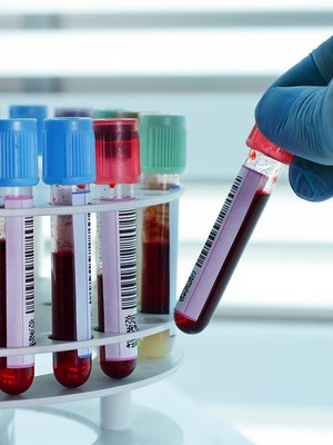 laboratoriokokeet, kolesteroli, verenpaine, sokerirasitus