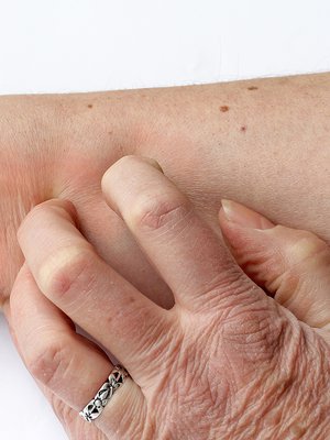 kutina, atopia, kuiva iho, kortisoni