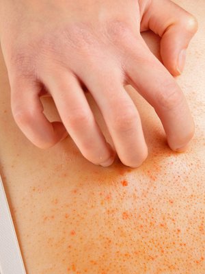 melanooma, ihosyöpä, kutina