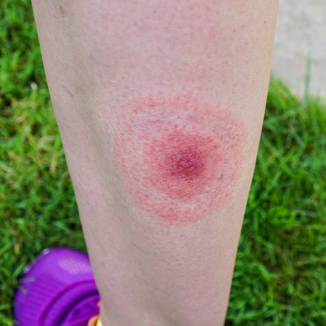 punkki, puutiainen, borrelioosi, Lymen borrelioosi