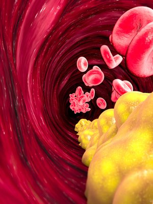 Sekä hyvä että huono kolesteroli kulkee verisuonissa lipoproteiiniin pakattuna.