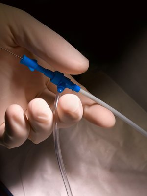  katetrointi sydän katetriablaatio