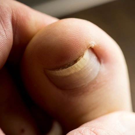 Jos kynsi painaa kynnen vierustan eli kynsivallin herkkää ihoa, syntyy helposti kipeä kynsivallin tulehdus.